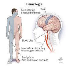 Stroke Diagram Image